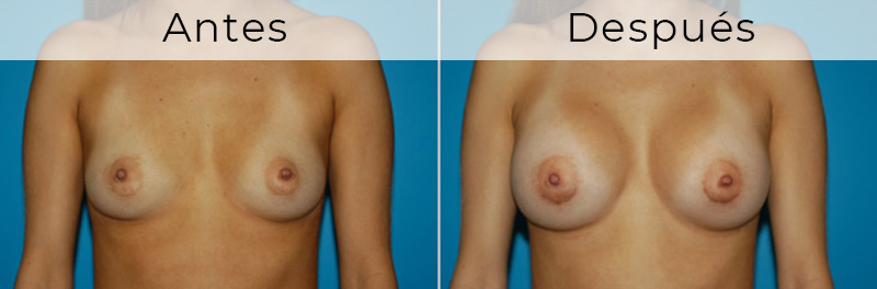 antes y despues mamoplastia de aumento
